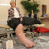 Shrinking my 17stone legs: Hope for woman whose limbs wouldn't stop growing after doctors develop pioneering treatment